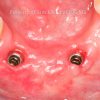 1-Two-Dental-Implants-1024x767_preview