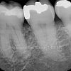 2 Bone graft After_preview