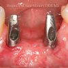 2-Two-Dental-Posts-Abutments-1024x768_preview
