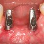 2-Two-Dental-Posts-Abutments-1024x768_preview