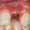 2-single-implant-dental-implant-placed_preview