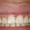3 Esthetic Crown Lengthening Before_preview