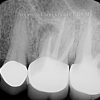 3 Infected Tooth_preview