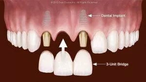 3-unit-implant-bridge anterior_preview - Dental Implants PA, Gum