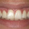 4 Esthetic Crown lengthening After_preview