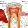 4 Gum Disease _preview