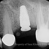 6 Dental Implant_preview