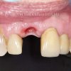 6 Single Dental Implant Before_preview