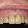 7 Single Dental Implant After_preview