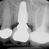 8 Dental Implant Crown_preview