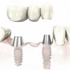 Dental-Implant-bridge-posterior_preview