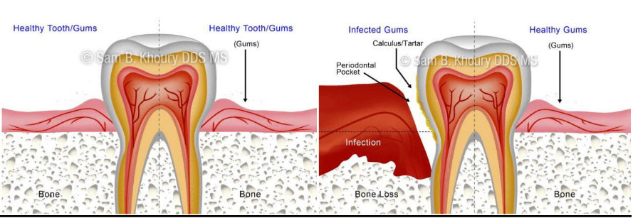 Untitled 1 - Gum Disease Information