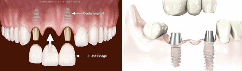 z4 - Multiple Dental Implants