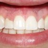 1-Esthetic-Crown-Lengthening-Before_preview-1