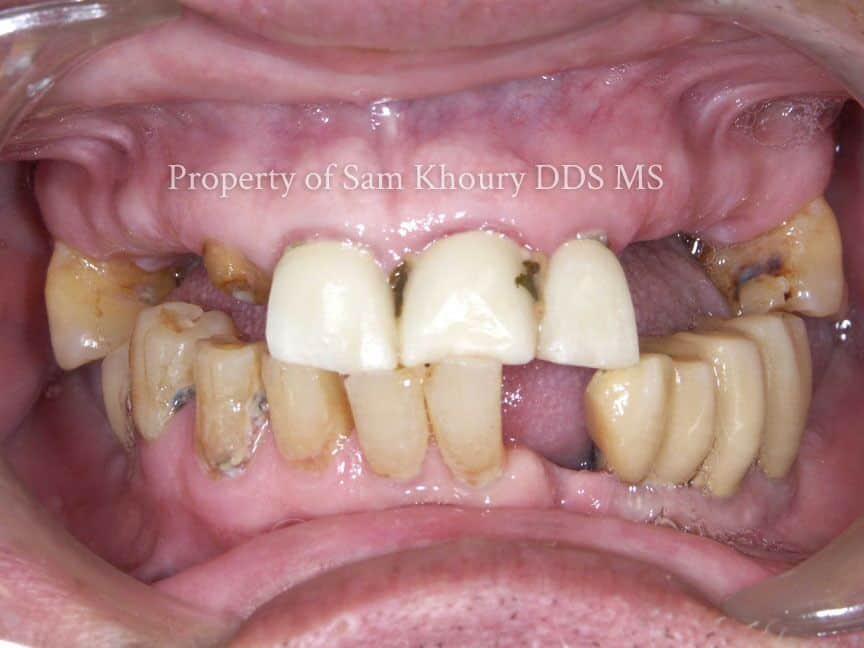 12 All on Four Befiore 1 preview 1 - Full Mouth Dental Implants