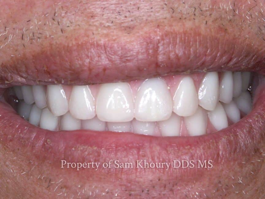 Dental Implants Media PA