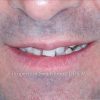 2-full-mouth-reconstruction-before_preview-1
