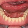 3-Overdenture-3-implants_preview-1