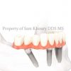3-fixed-denture_preview-1
