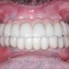 3-full-mouth-reconstruction-after_preview-1