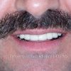 4-full-mouth-reconstruction-after_preview-1 4-full-mouth-reconstruction-after_preview-1