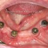5-Overdenture-4-implants_preview-1 5-Overdenture-4-implants_preview-1