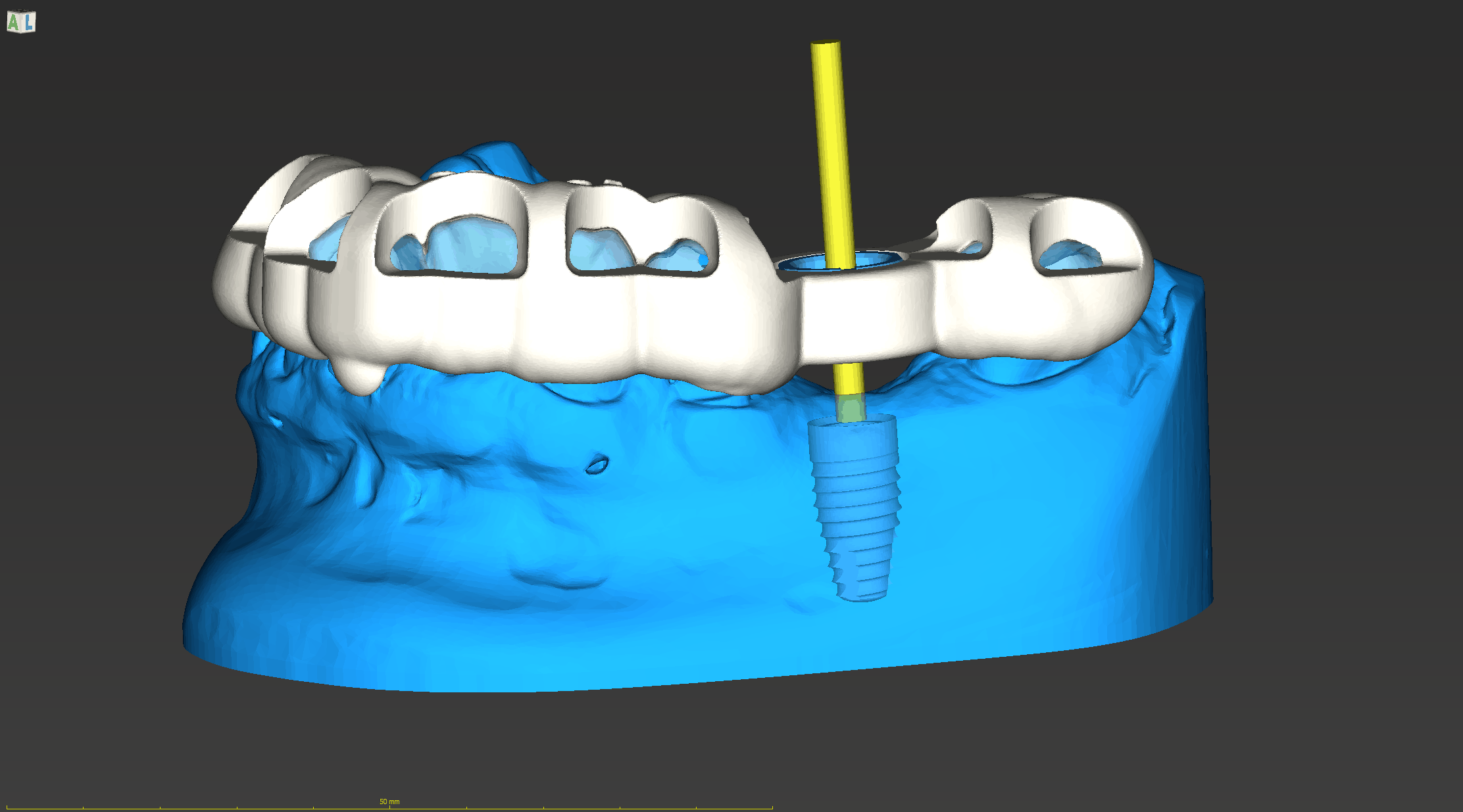 Image 3 Surgical guide a - Guided Dental Implant Surgery