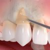 Gum_recession_treatment_03 Gum_recession_treatment_03