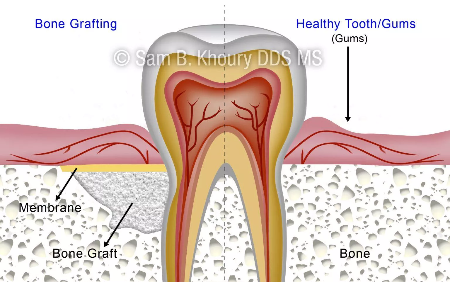 Bone Grafting Dr Sam Khoury