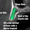 CBCT cross section implant