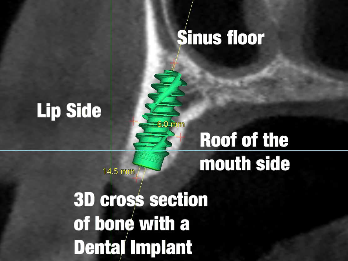 CBCT cross section implant