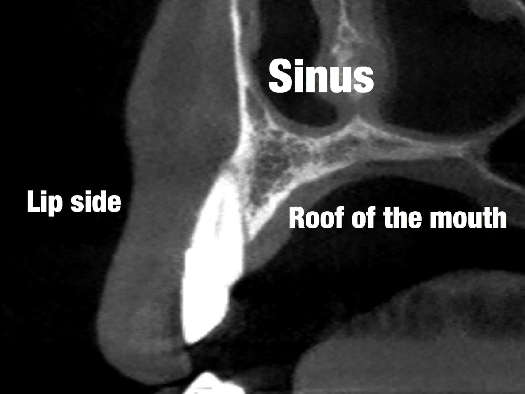 CBCT cross section tooth