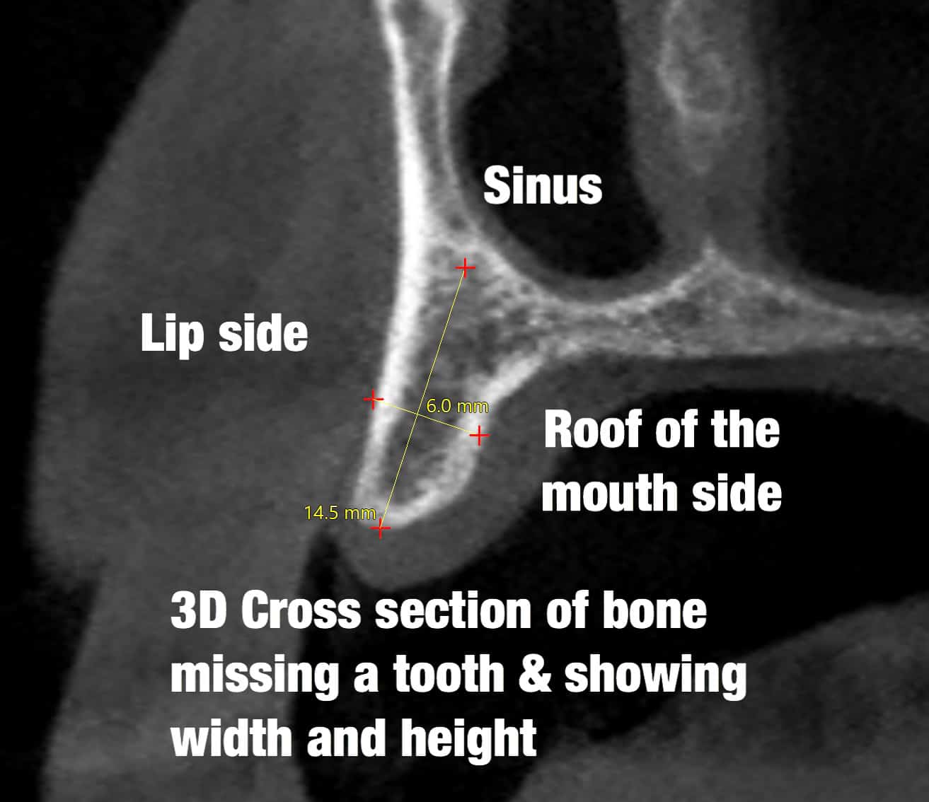 CBCT cross section