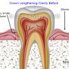 Crown lengthening cavity 1