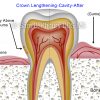 Crown lengthening cavity 2