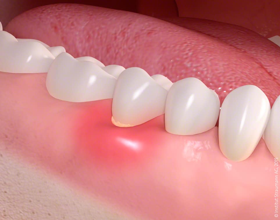 Gum disease treatment 01 1 - Biomaterials