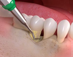 Gum disease treatment 03 300x236 - Biomaterials