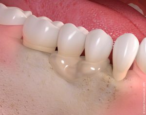 Gum disease treatment 05 300x236 - Biomaterials