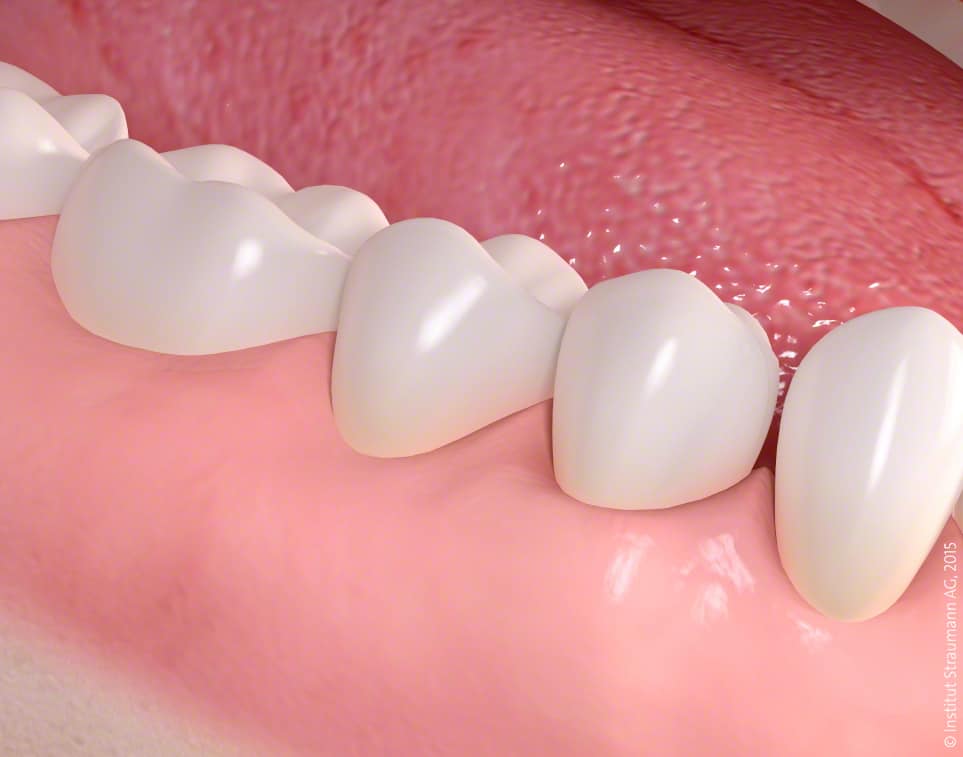 Gum disease treatment 06 1 - Biomaterials