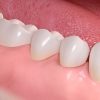 Gum_disease_treatment_06
