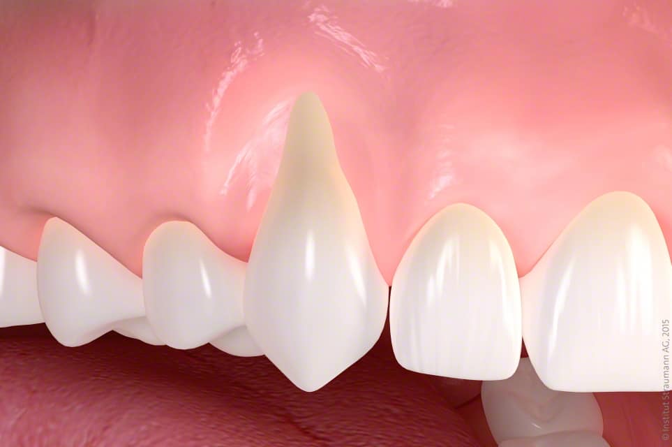 Gum recession treatment 01 - Biomaterials