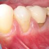 gum Grafts-Before and after