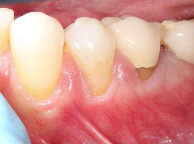 Gum Grafts Before and After Dr. Sam Khoury