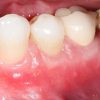 Dental Implants Doylestown PA