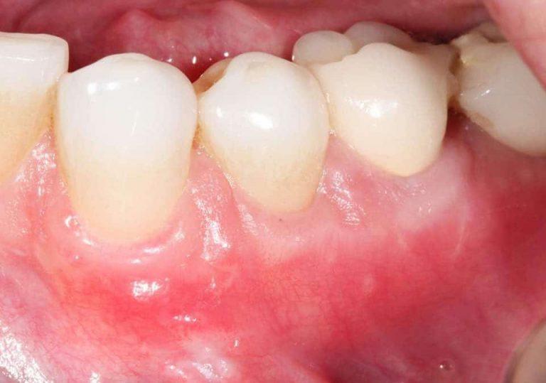 Gum Grafts Before and After Dr. Sam Khoury