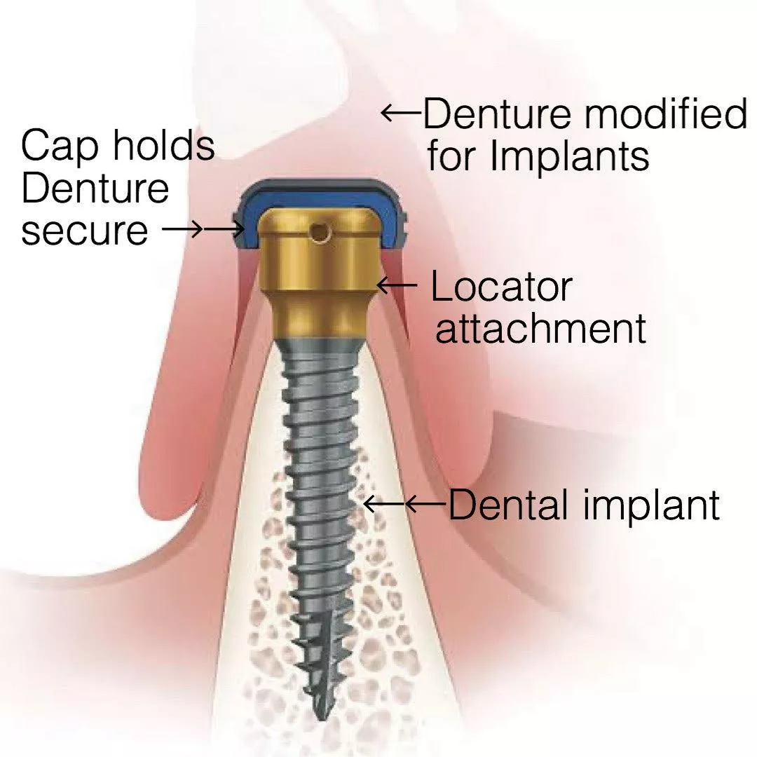 Overdentures Dental Implant & Periodontal Surgeons