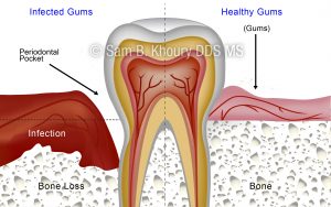 Gum Disease Surgical Procedures