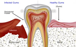 Gum Disease Surgical Procedures