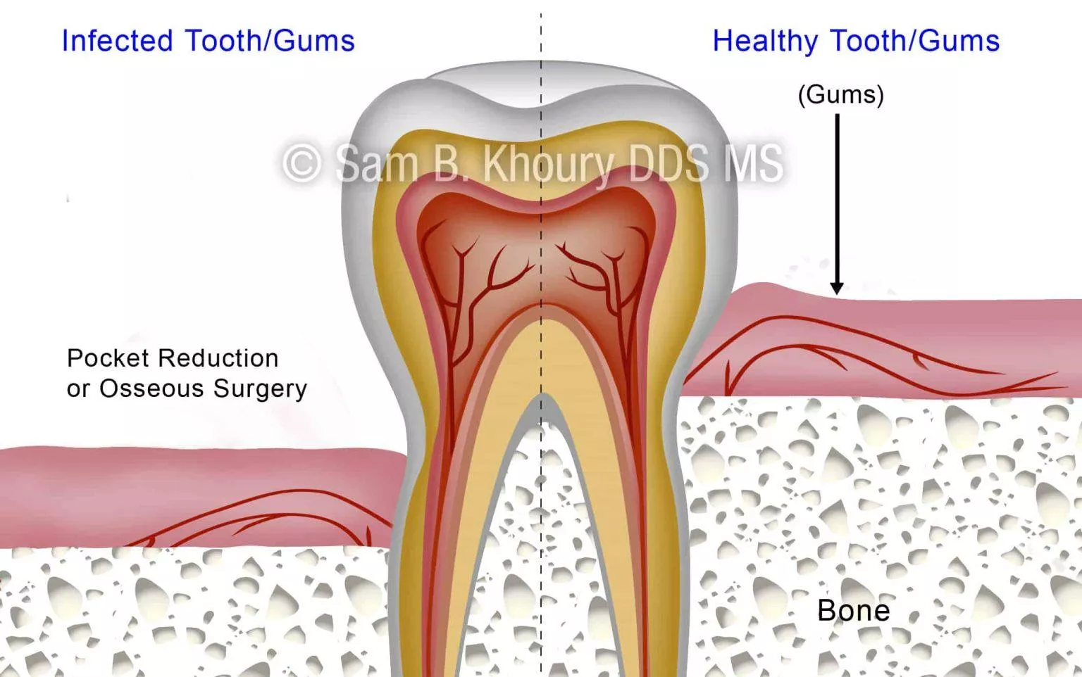Gum Disease Surgical Procedures Pocket Reduction Surgery