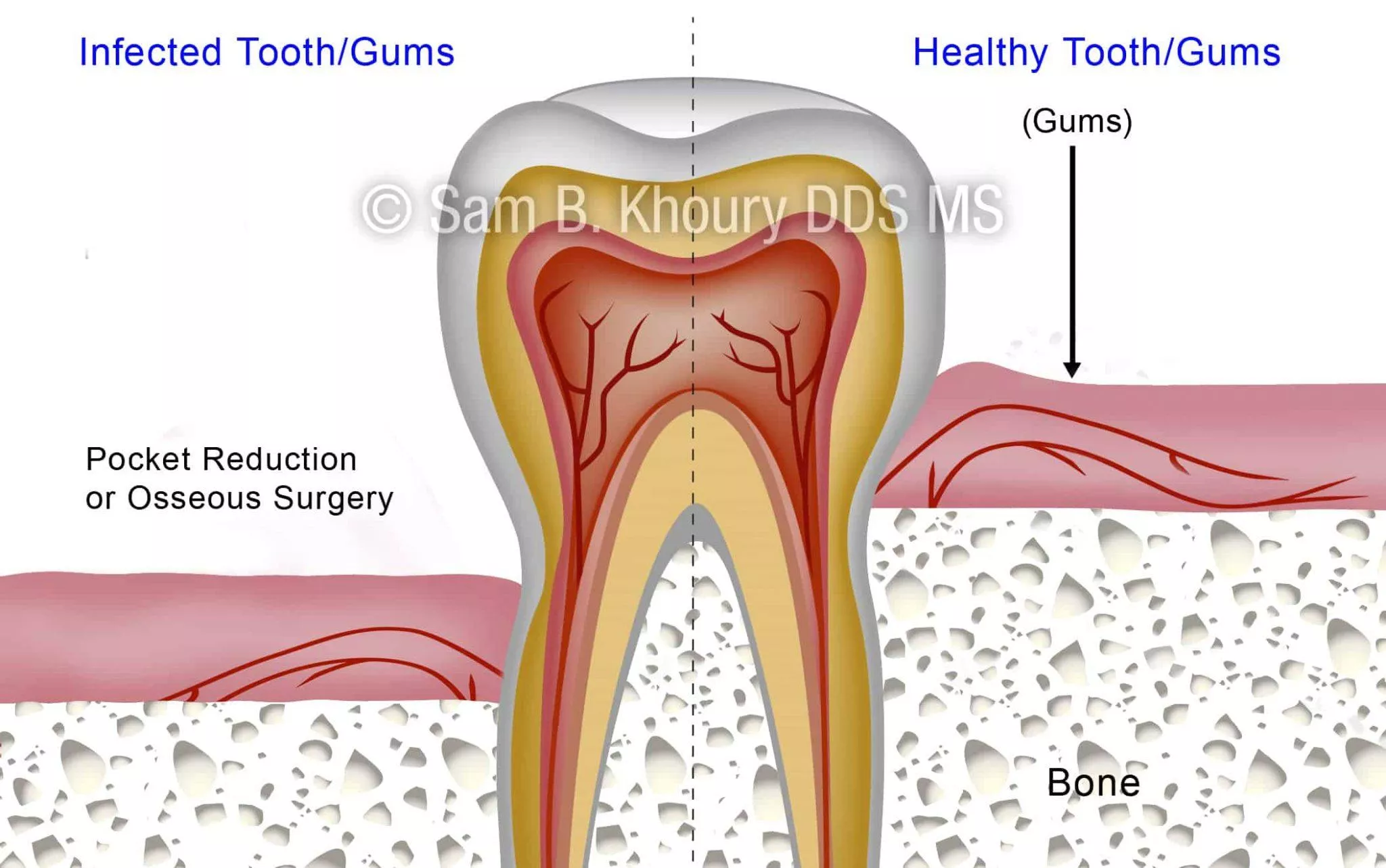 Gum Disease Surgical Procedures Pocket Reduction Surgery